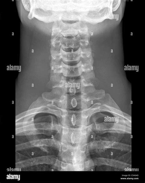 Normal Neck X Ray Stock Photo Royalty Free Image 37879869 Alamy