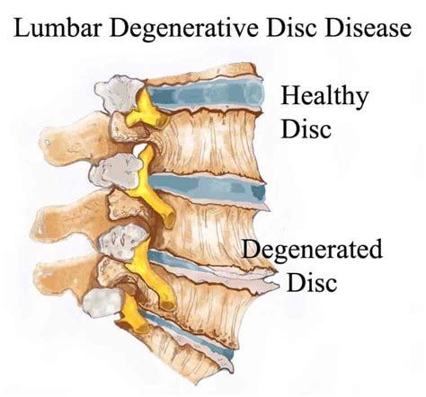The Disc Disease In Neck