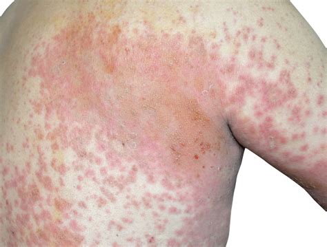 7 Types Of Eczema Cottonique Allergy Free Apparel