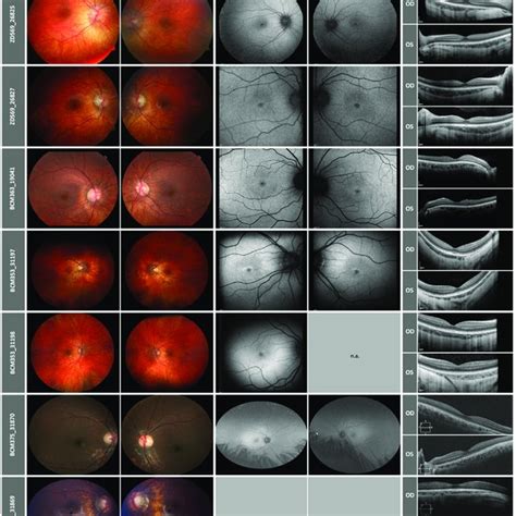 Retinal Imaging Of The Patients With Fundus And Fundus Autofluorescence