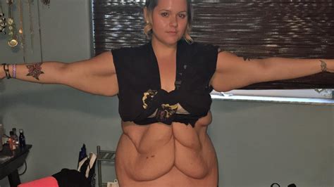 Weight Loss What Its Like To Have Kg Of Excess Skin Removed Photos The Advertiser