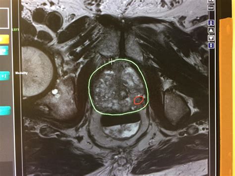 Mri Guided Fusion Biopsy Of The Prostate