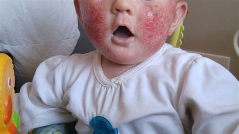 Mums Warning As Baby With Extreme Eczema Screams Like Shes On Fire
