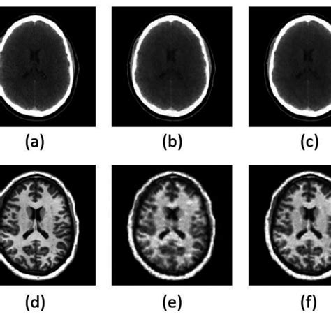 Comparison Between Individual Ctmr Reconstructions Unified Ct Mri