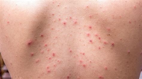 How To Prevent And Treat 8 Common Skin Conditions