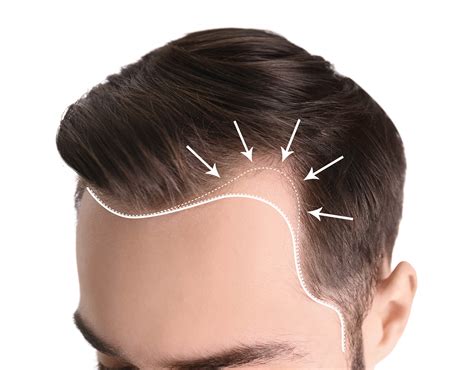 Temple Hair Loss A Sign Of Androgenic Alopecia Myhair