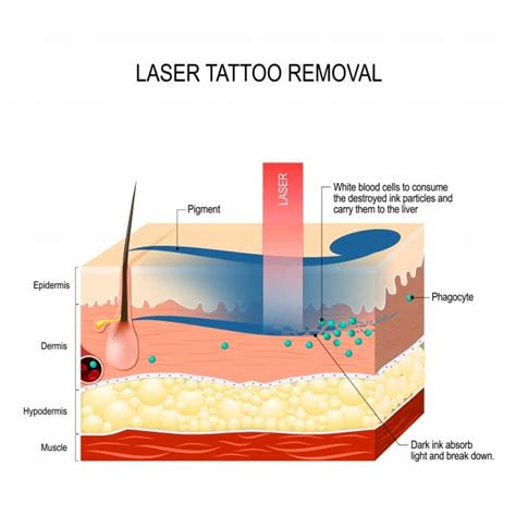 How Does Laser Tattoo Removal Work Bairdmd