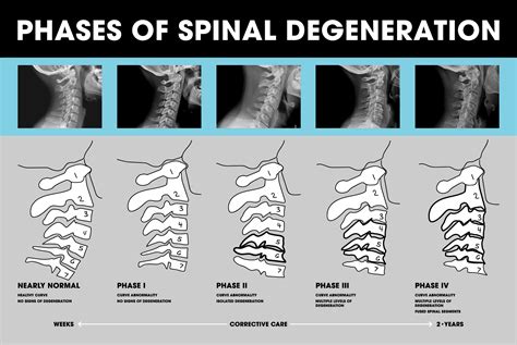 Spinal Degeneration Mind Tweak