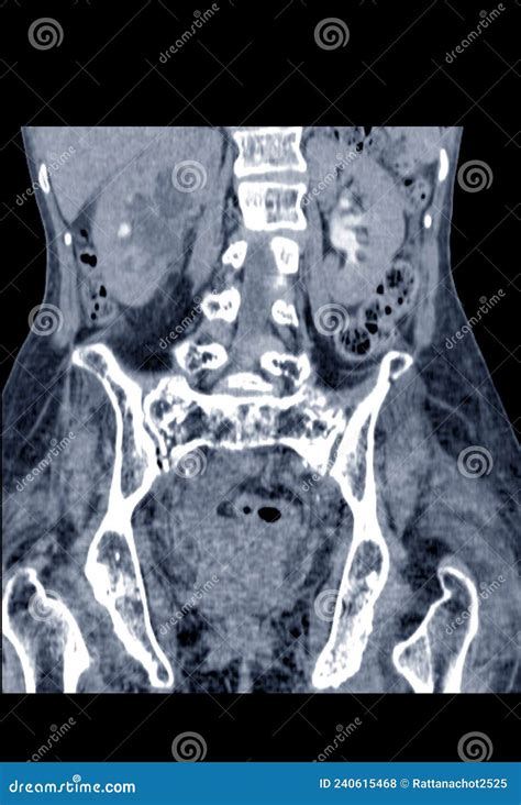 Hydronephrosis X Ray