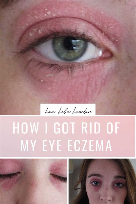 A Photograph Of A Womans Face And Eyes With Severe Eye Eczema Redness