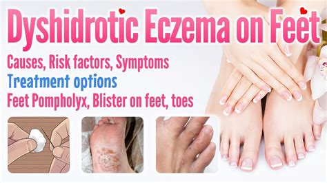 Dyshidrotic Eczema