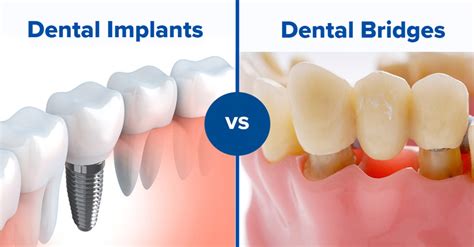 Dental Crowns Vs Bridges Whats The Difference Dentist Sydney