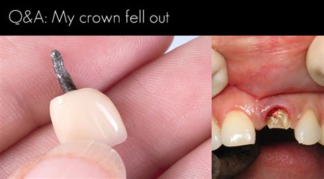 My Crown Fell Out Windsor Dentists