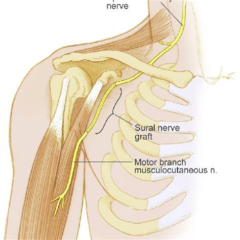 Transfer Of The Posterior Branch Of The Axillary Nerve Branches To The
