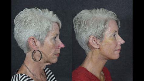 Rapid Facelift Recovery For 62 Year Old Woman 1 Week After Surgery Dr