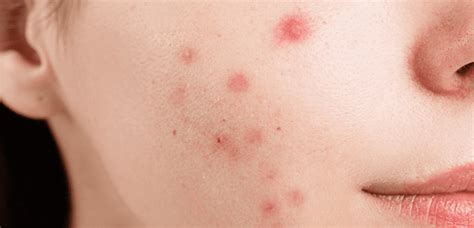 Fungal Acne Causes Symptoms And Treatment Options