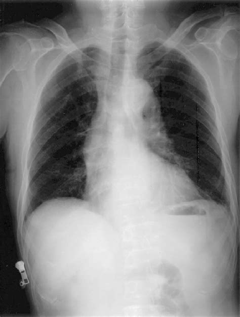 Chest X Ray Tortuous Aorta