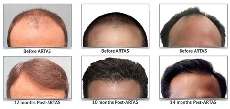 About ARTAS The Hair Restoration Specialist Tom Rosanelli M D