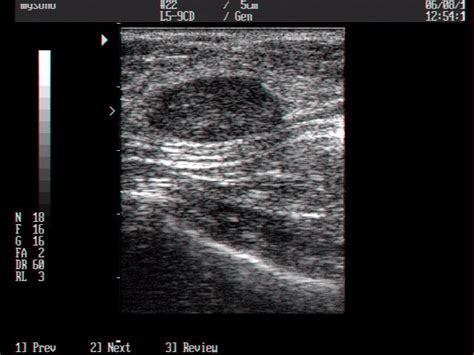 Breast Ultrasound Fluid Filled Cyst In Breast Ultrasound