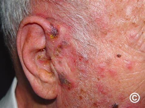 Herpes Zoster Syn Shingles