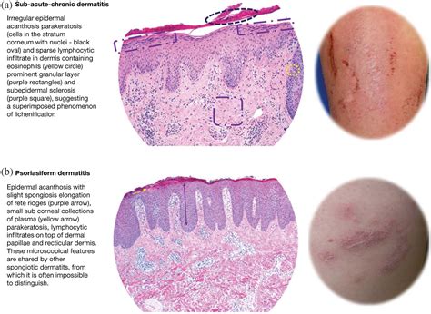 Nomenclature And Clinical Phenotypes Of Atopic Dermatitis Giampiero