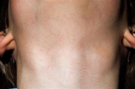 Swollen Lymph Nodes In Neck Images And Photos Finder