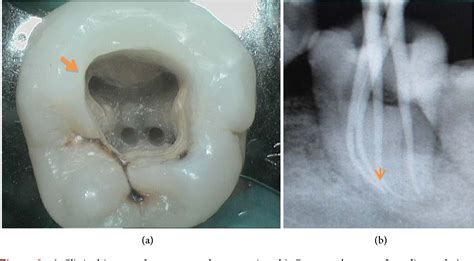 Pdf Root Canal Treatment Of Mandibular First Molar With Radix