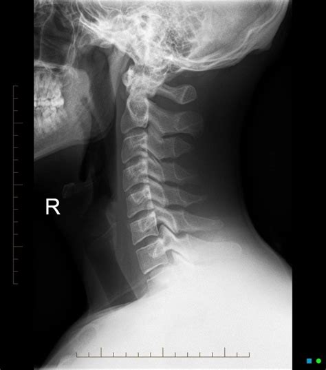 X Ray Cervical Spine Ap And Lat View