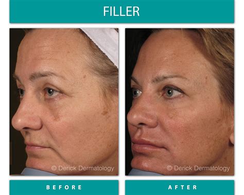 31fillerbefore After1500x1200px Derick Dermatology