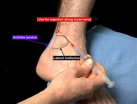 Lower Extremity Nerve Block The Sural Nerve Sinaiem