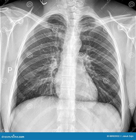 Chest Xray Of A Patient Showing Free Air In The Abdominal Cavity