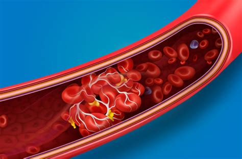 Passing blood clots in your urine, however, can be painful. Should You Be Worried About Blood Clots With COVID-19 ...