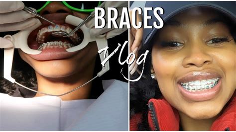 Best Way To Help Braces Pain Ways To Ease Braces Pain Omar