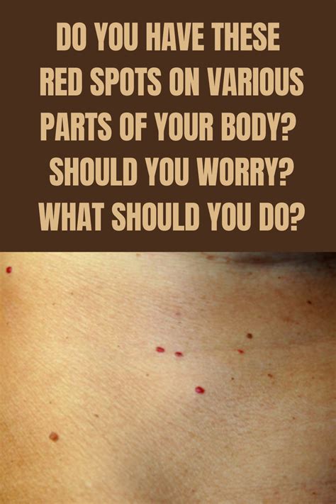 Do You Have These Red Spots On Various Parts Of Your Body Should You