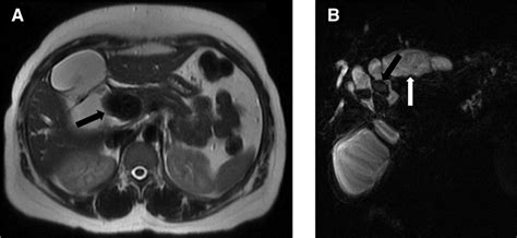 An Axial T2 Weighted Mri Of The Abdomen A Demonstrates A Large T2
