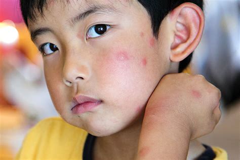 3 Simple Steps To Treat Insect Bites In Children