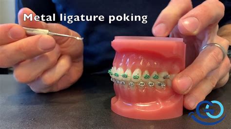 Braces Fix Metal Poking From Orthodontic Bracket Youtube