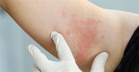 Why Do Hives Occur With Hiv