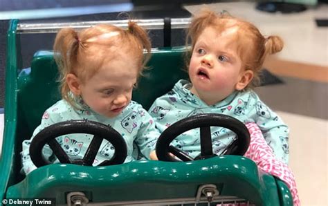 Twins Formerly Conjoined At Brain Learning How To Walk And Talk Two
