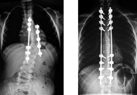 About Spinal Fusion Surgery Wellness In Motion