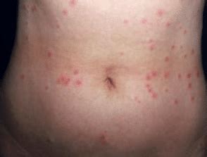 Rashes and itching all over body with welts.increasing all over body daily? Red Spots on Body, not Itchy, Random, Small, Pictures ...