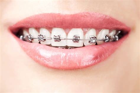 What To Know Before Getting Braces As An Adult Vincent Team Orthodontics
