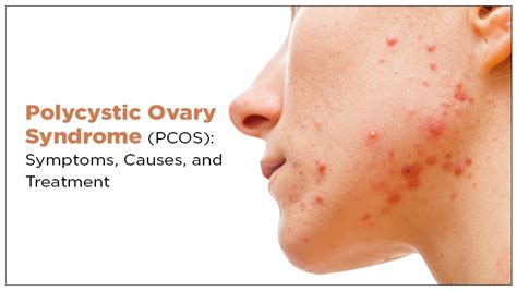 Polycystic Ovary Syndrome Pcos Symptoms Causes And 24mantra