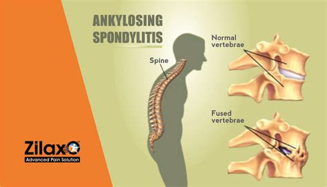 Zilaxo Advanced Pain Solution 7 Easy Exercises For Ankylosing Spondylitis