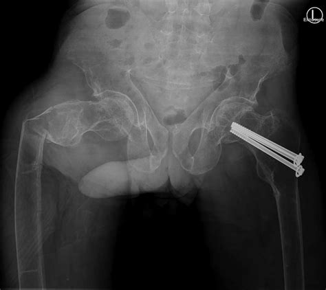 Anterior Posterior View Right Sided Subtrochanteric Femoral Fracture