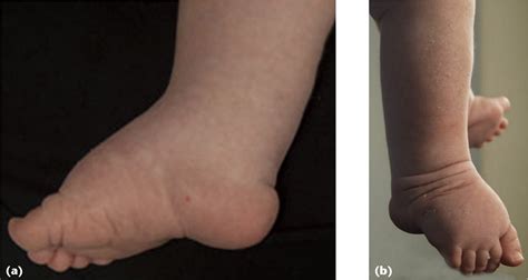 Challenging Clubfeet The Arthrogrypotic Clubfoot And The Complex