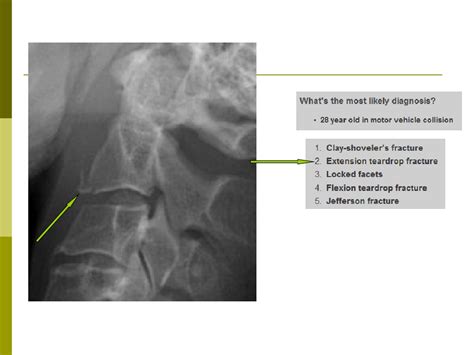 Cervical Fracture