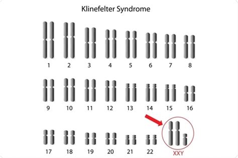 Klinefelter Syndrome Treatment