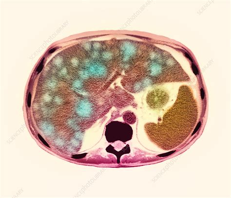 Liver Cancer Ct Scan Stock Image M1340374 Science Photo Library
