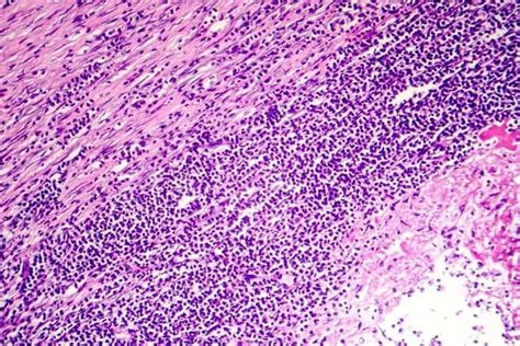 I sintomi di miocardite e pericardite la miocardite è un' infiammazione acuta delle cellule del miocardio e si manifesta con palpitazioni, aumento della frequenza cardiaca, senso di oppressione. Pericardite: sintomi, cause e trattamento - Vivere più sani